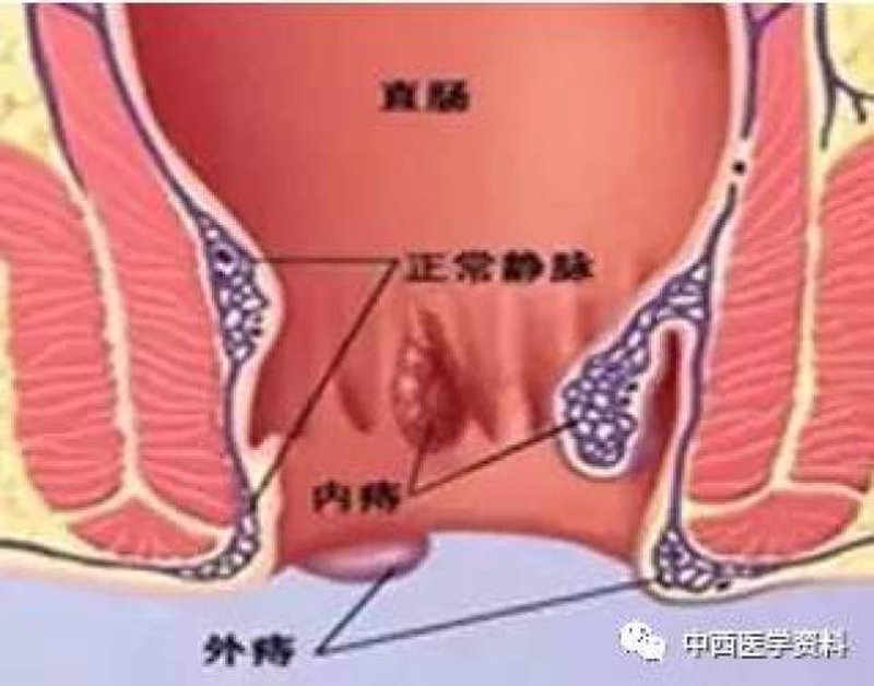 肛裂: 了解这一常见疾病背后的专业知识与应对策略